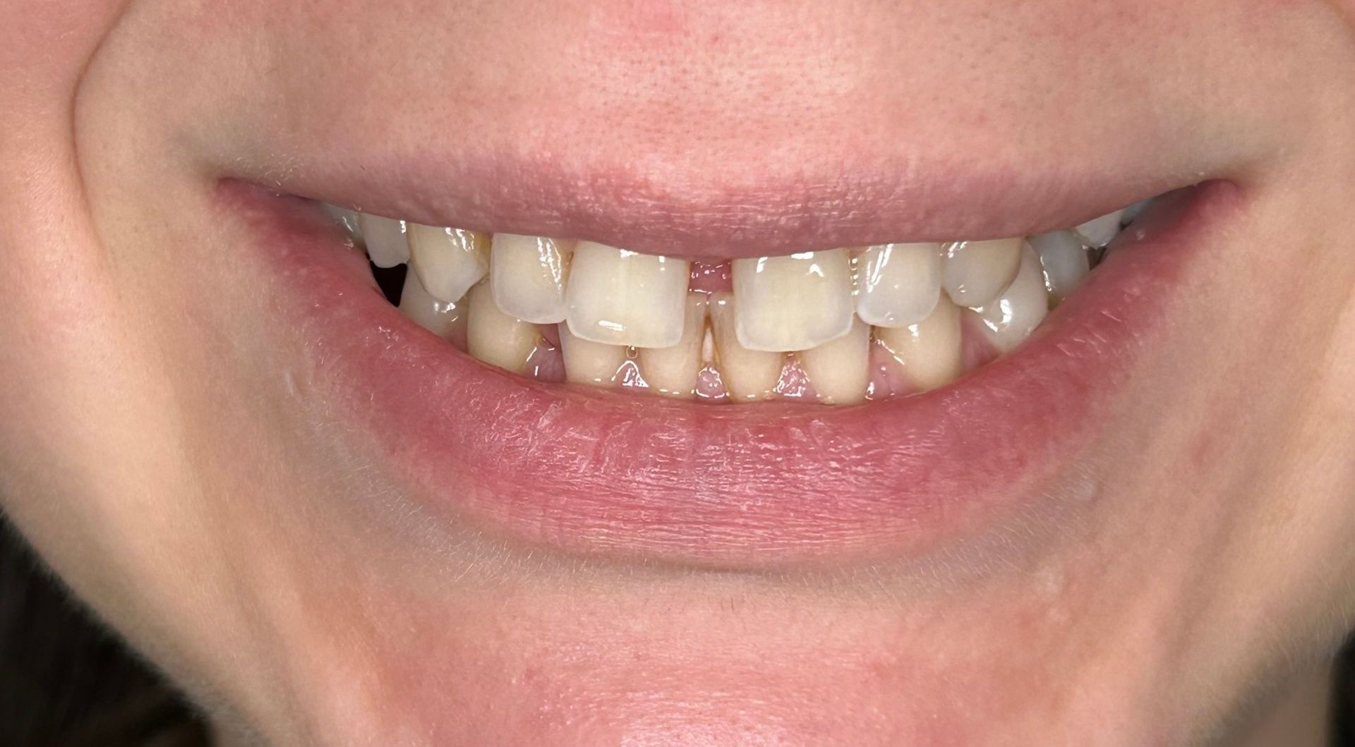 A close up of a person 's teeth with a smile on their face.