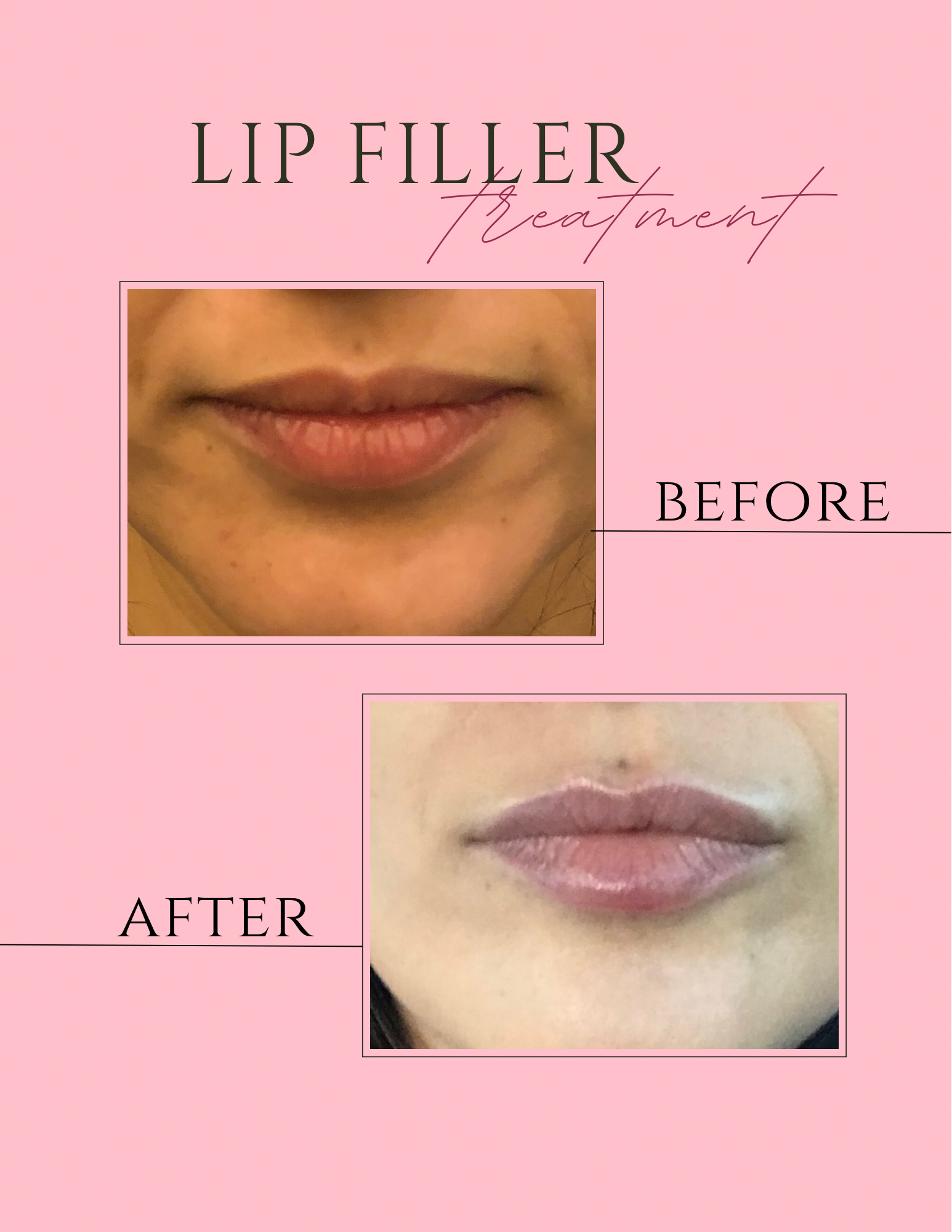 A before and after picture of a woman 's lips with lip filler.