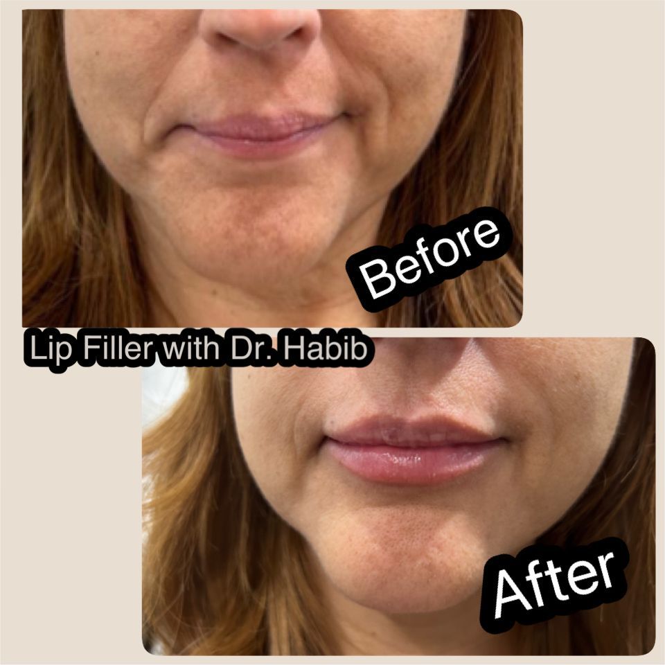 A before and after picture of a woman 's lips with lip filler.