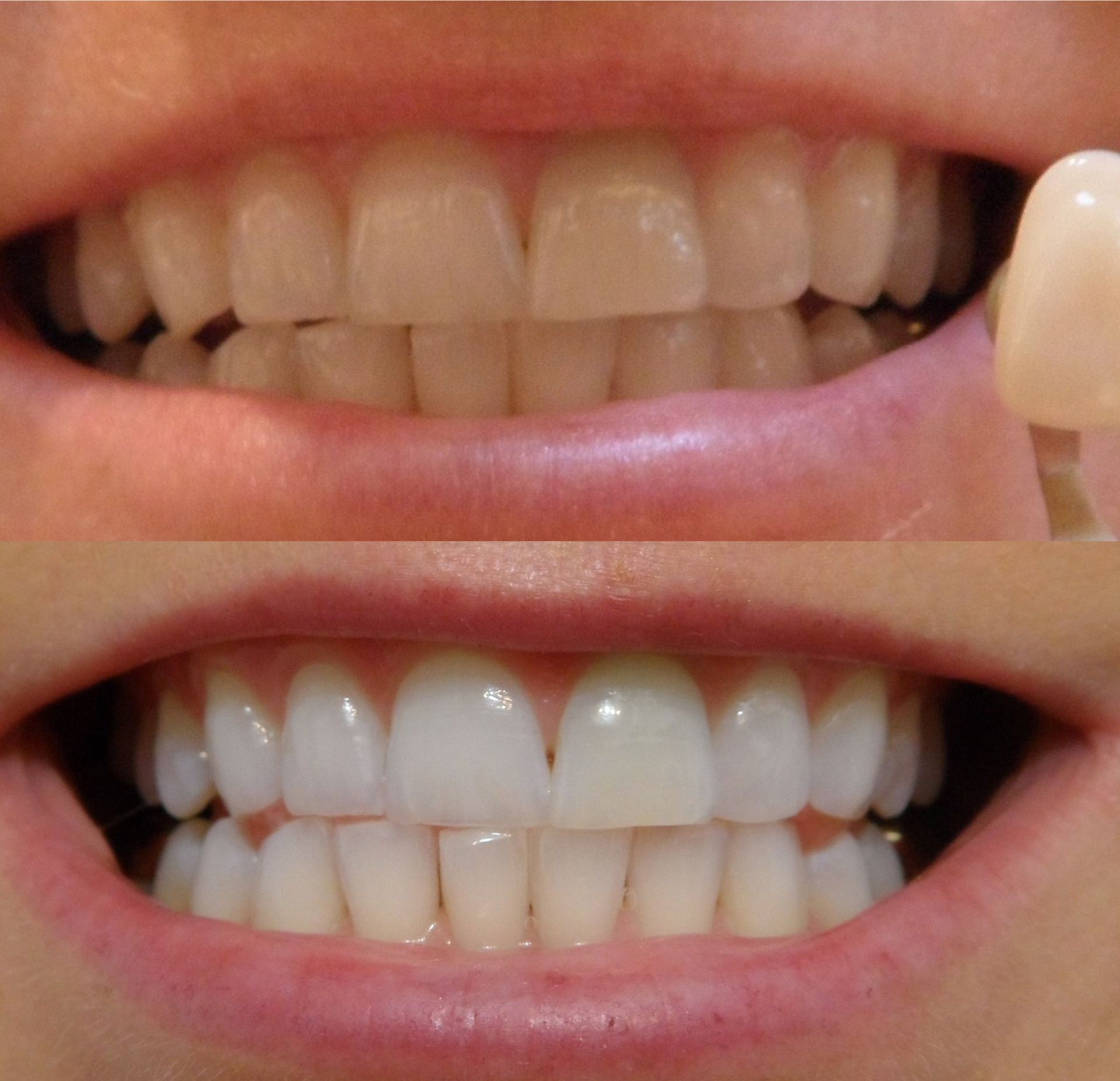 Teeth Before and After — Vandalia, OH — Serene Moments MedSpa