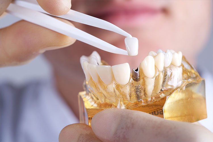 Doctor examining plastic model of teeth at Union Dental