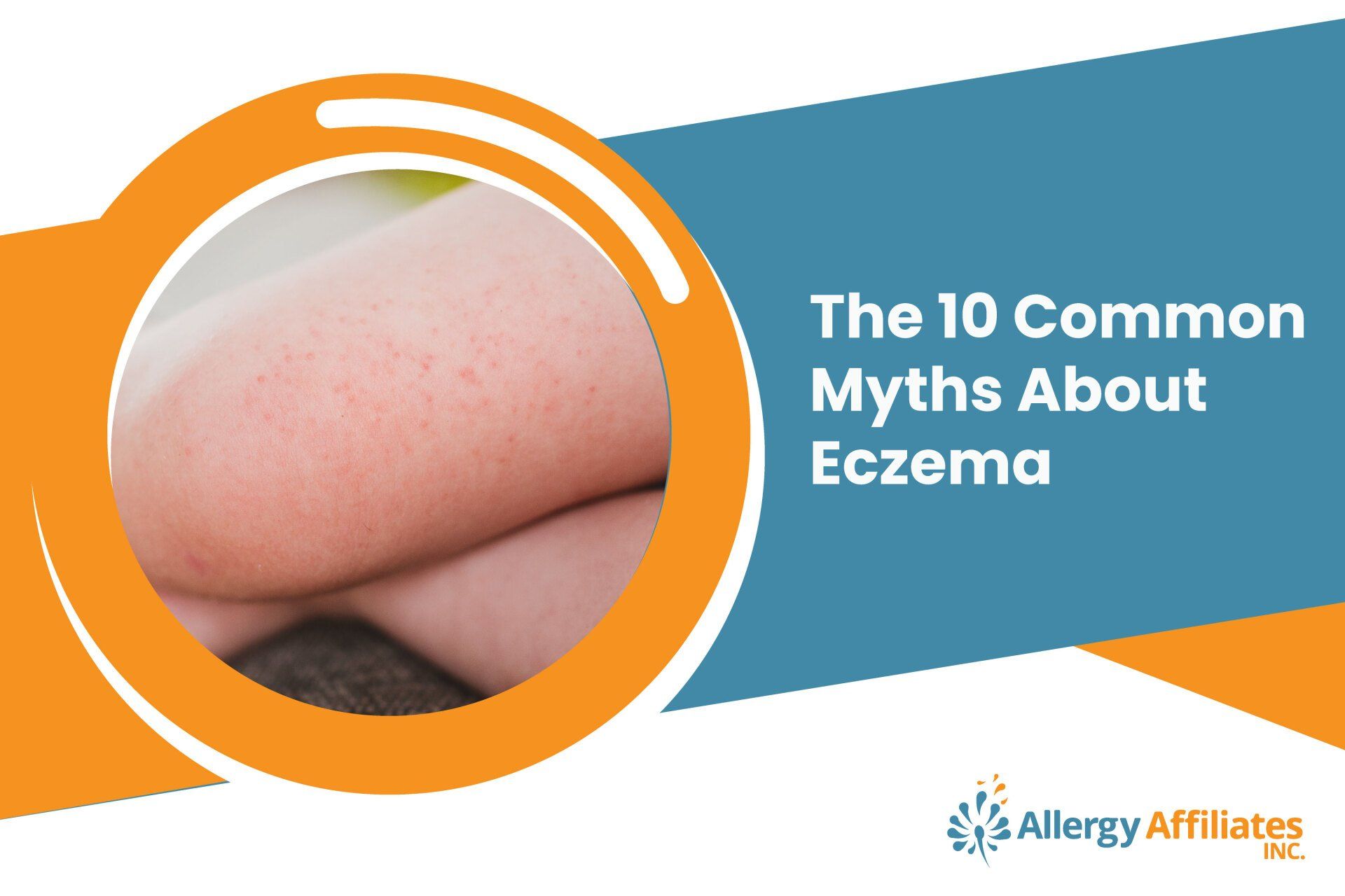 The 10 Common Myths About Eczema