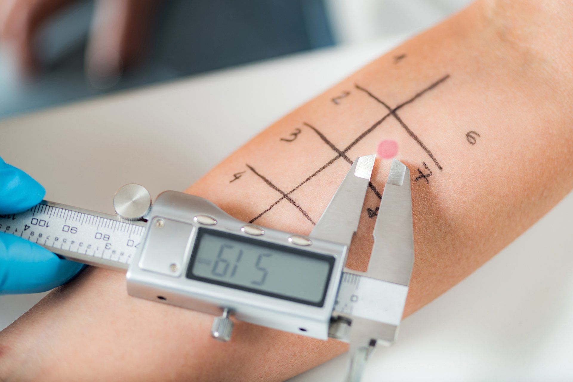 Allergy Affiliates - Doctor Measuring Allergic Reaction