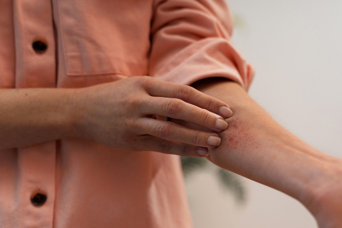 Why Does Eczema Act Up in Colder Weather?