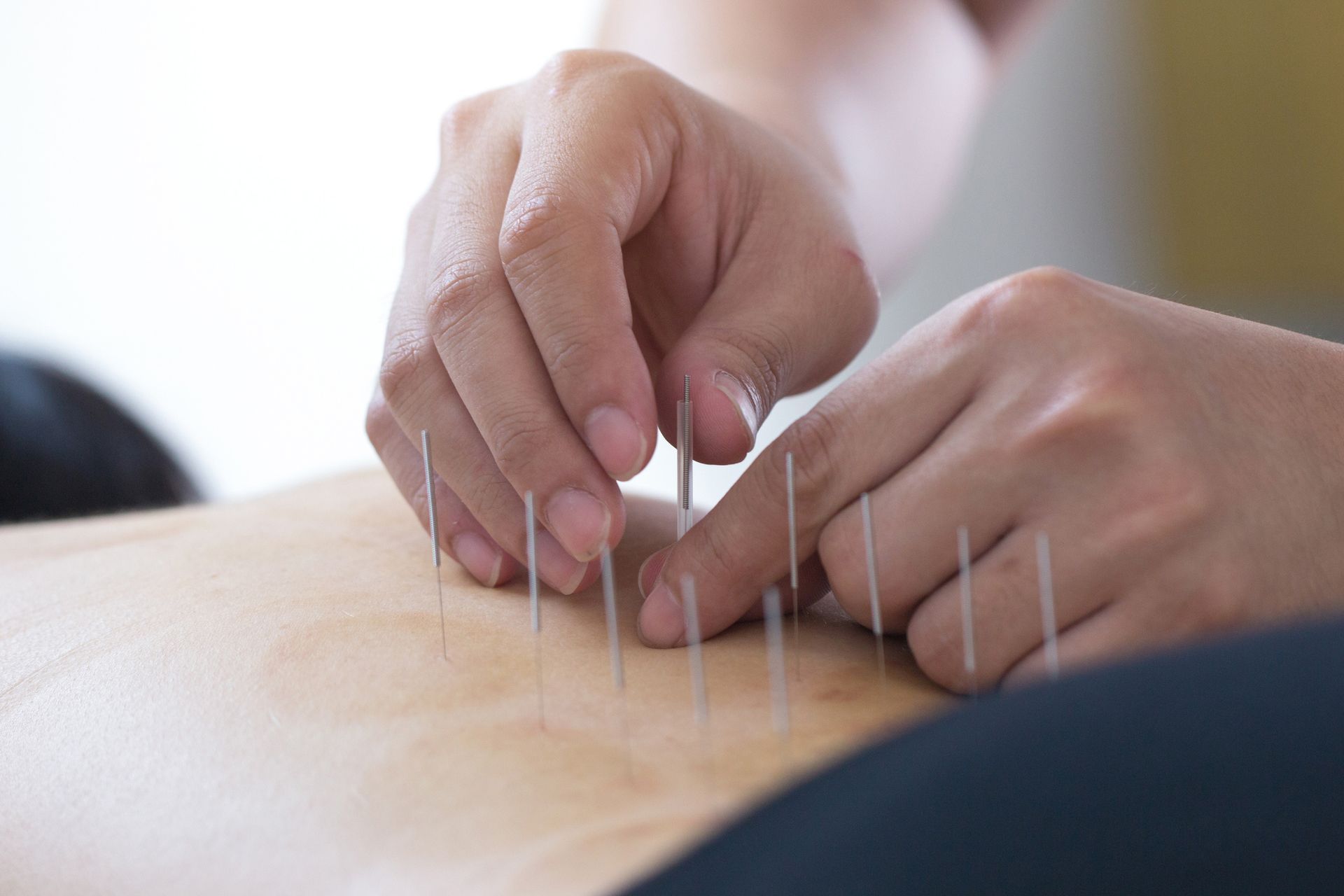 Acupuncture woman.