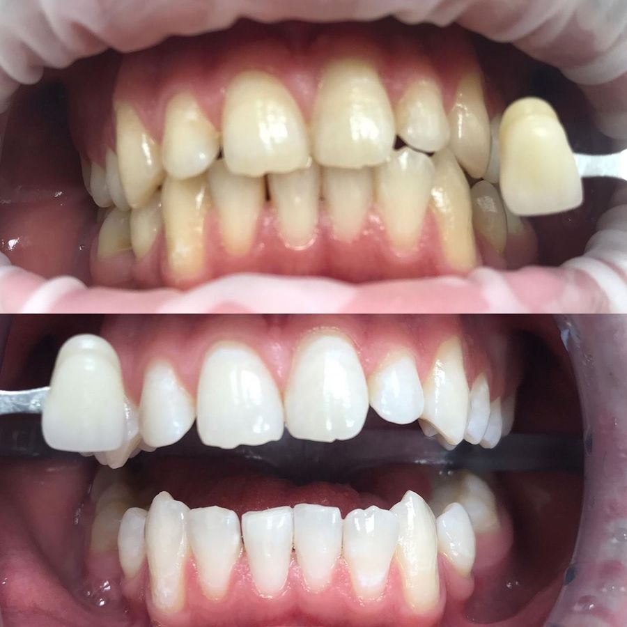 Prima e dopo lo sbiancamento dei denti. Fila superiore: denti ingialliti. Fila inferiore: denti bianchissimi.