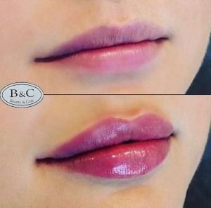 Persona con guanti blu che si inietta qualcosa in un gluteo, probabilmente per scopi estetici.