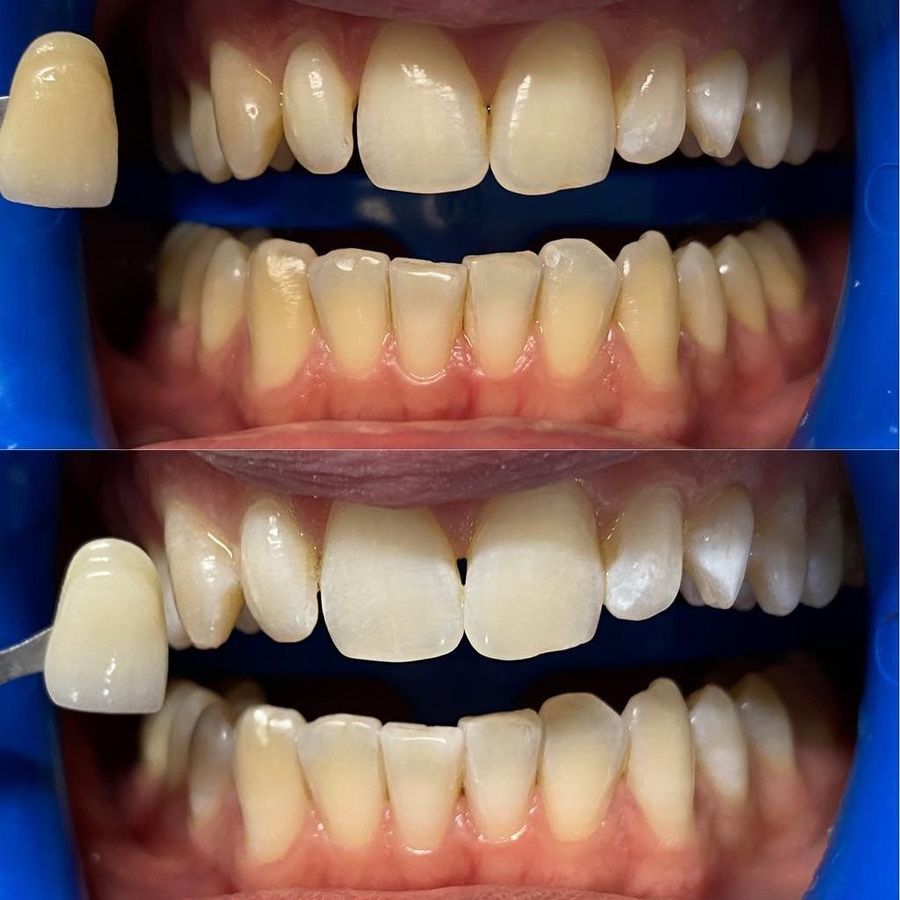 Due serie di denti affiancate, prima e dopo l'intervento di odontoiatria estetica. Include una scheda con la tonalità corrispondente.
