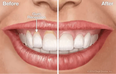 Image of Gum Contouring - Latest Dental Technology