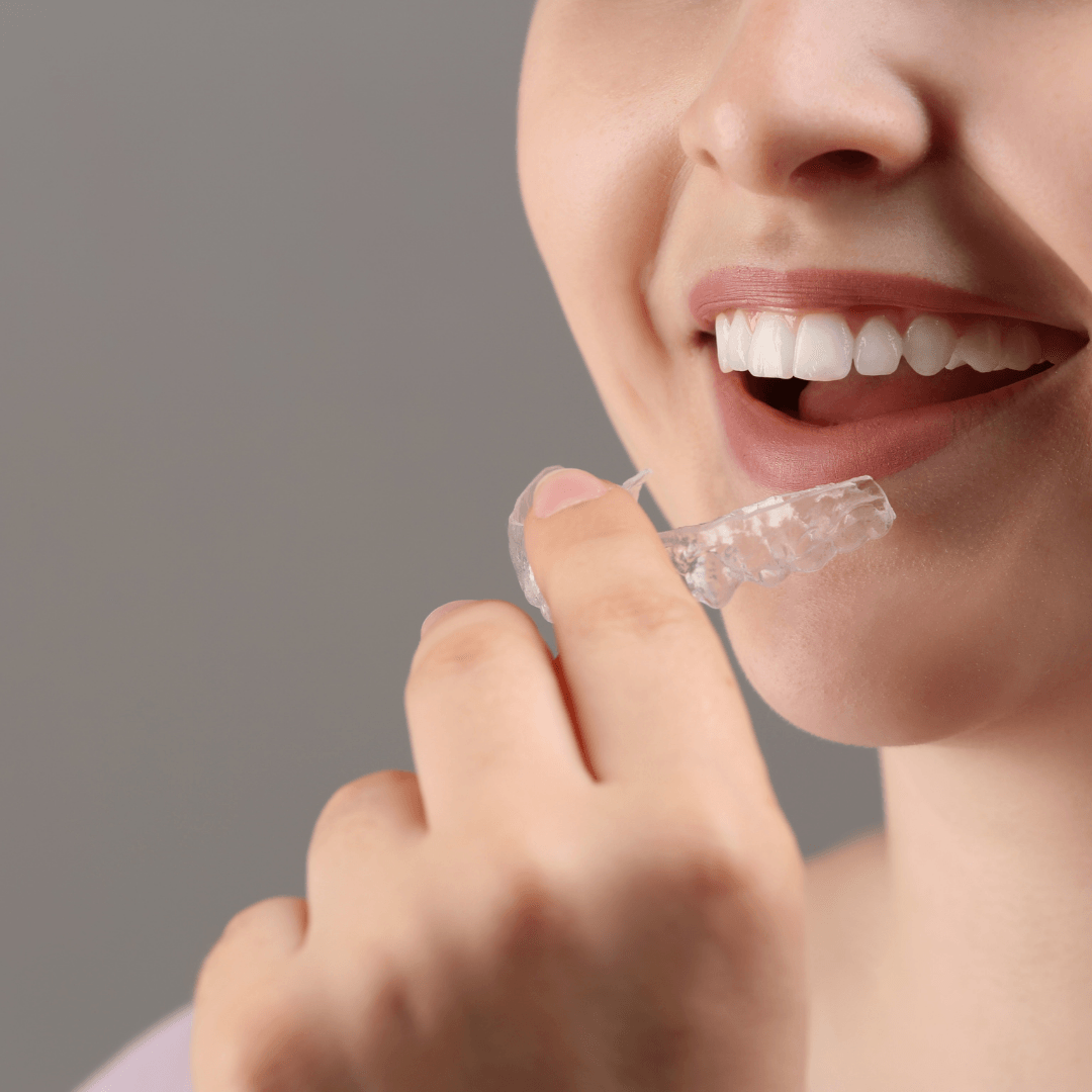 What is an Occlusal Guard? Do I need One?