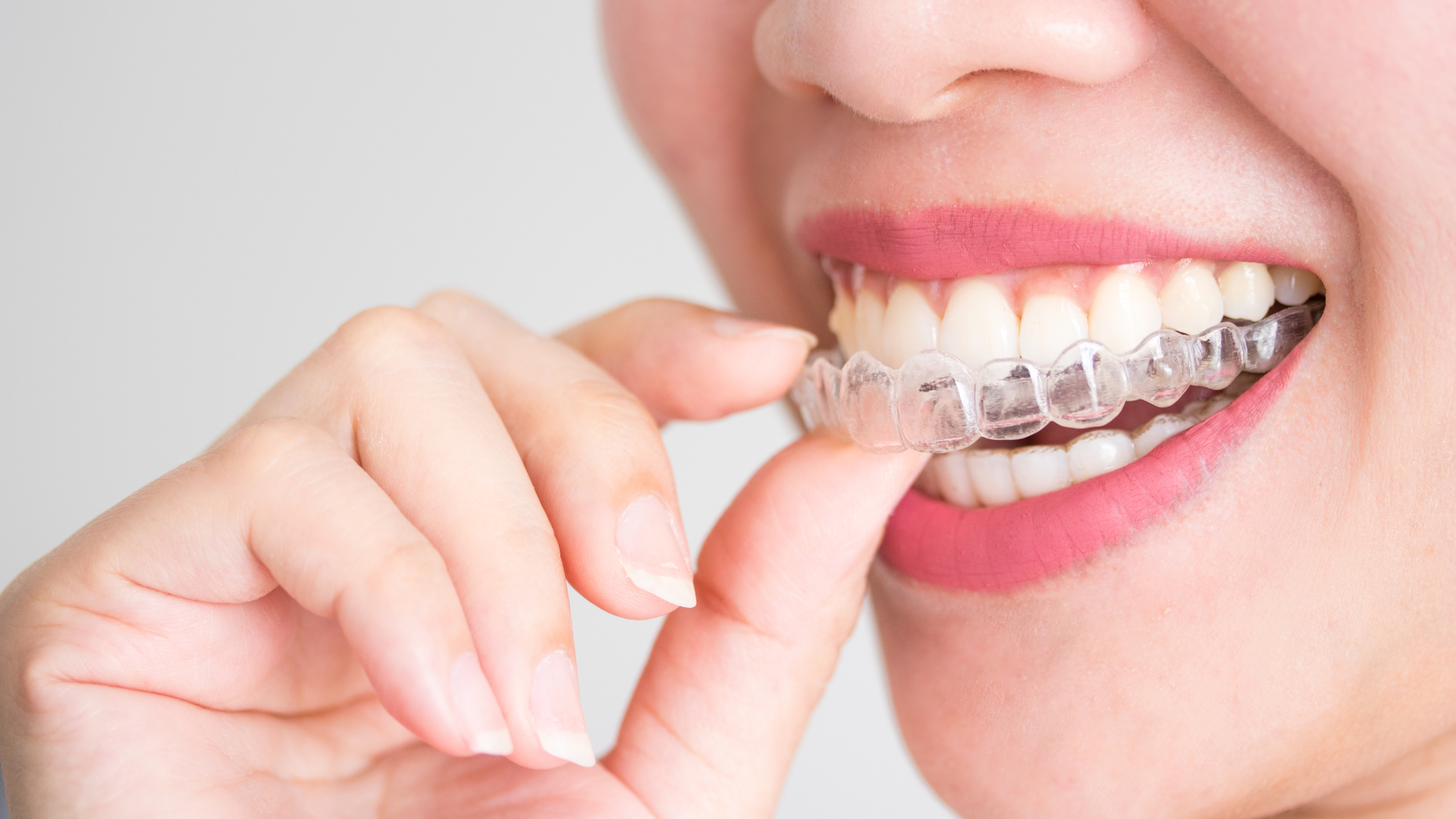 A woman is holding a clear brace in her mouth.
