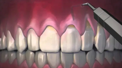 Image of Pinhole Surgical Technique - Latest Dental Technology