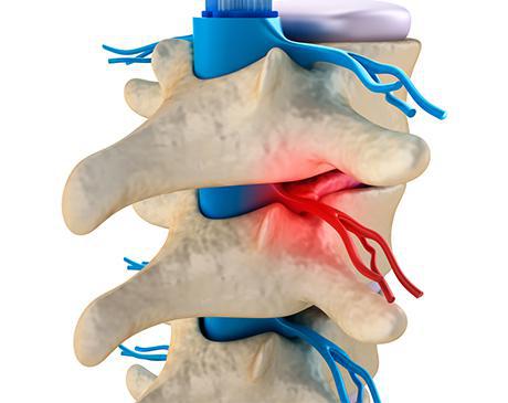 Subluxação vertebral