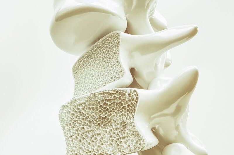 Cuidados Quiropráticos na Osteoporose