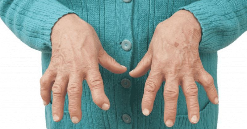 Quiropraxia pode ajudar a mulher com artrite reumatoide?