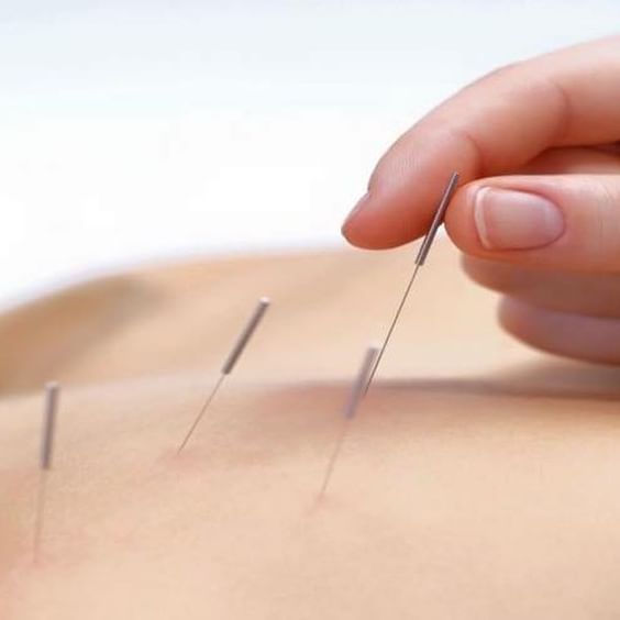 acupuncture
