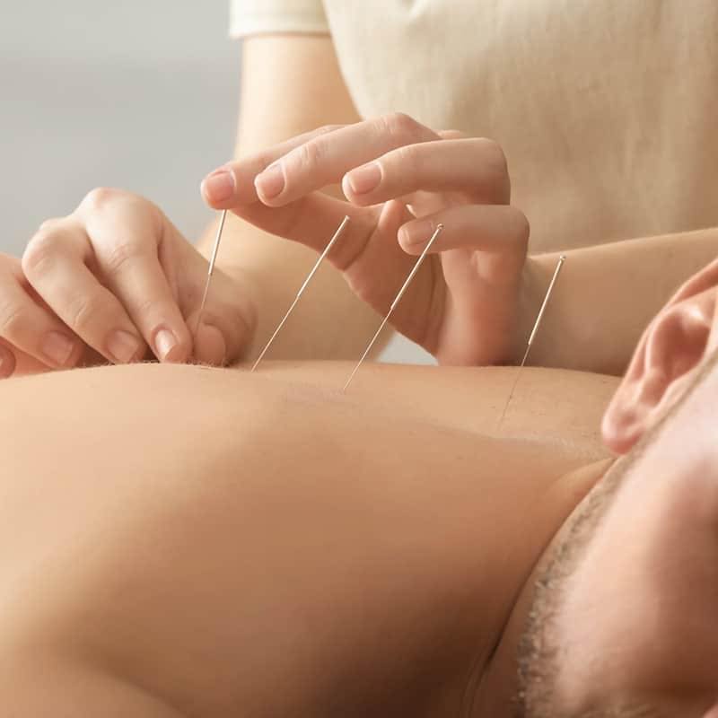 man getting acupuncture in back