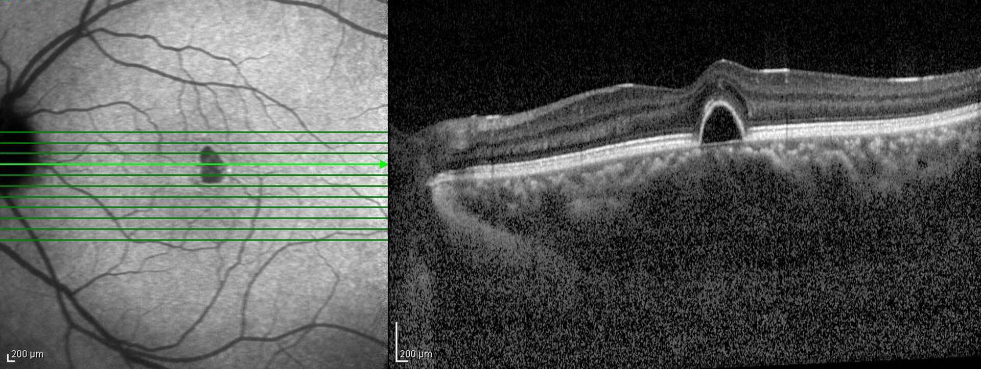 Clinical Applications of Optical Coherence Tomography — Woy Woy, NSW — Peninsula Eyecare Izzards Optometrists