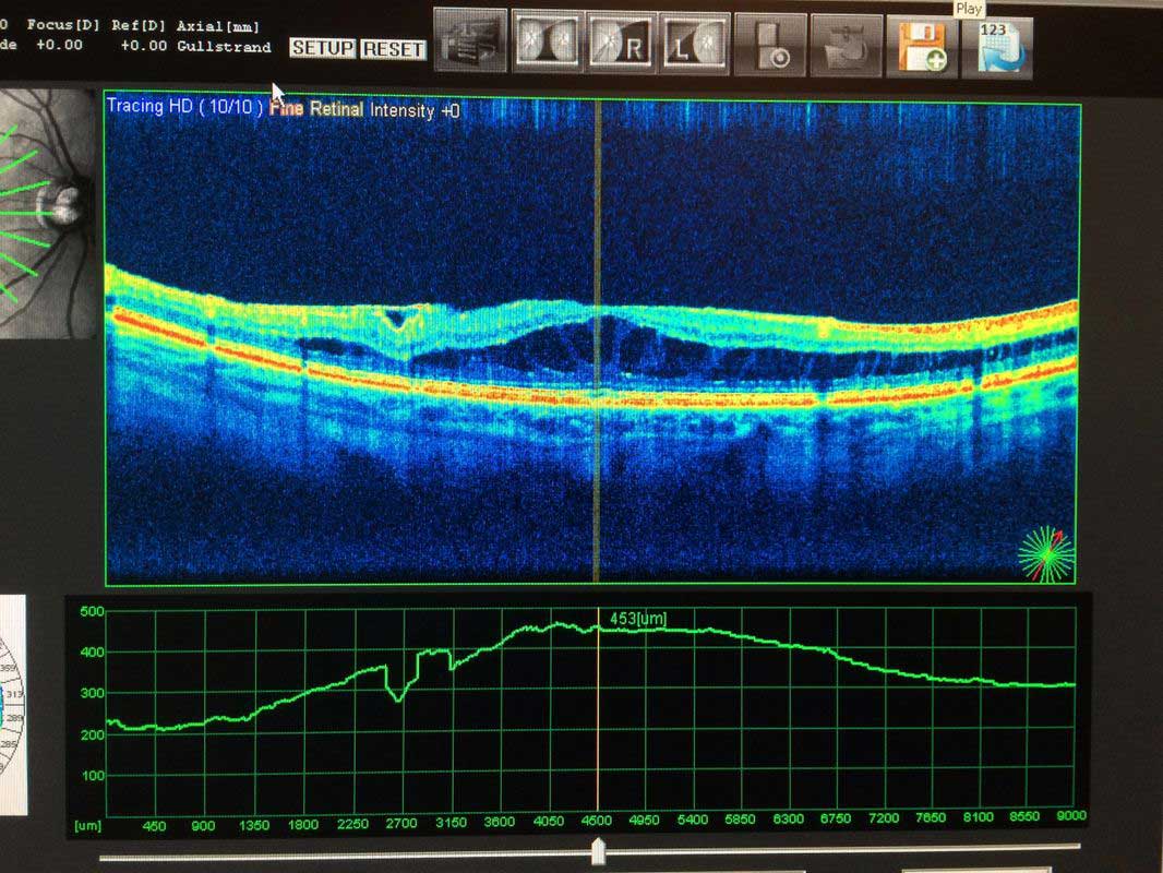 Axial Ultrasound Scan — Woy Woy, NSW — Peninsula Eyecare Izzards Optometrists