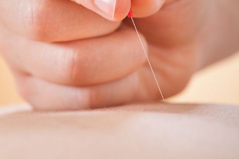 about Acupuncture by Jennie Chews Essence of Healing in Grays, Thurrock