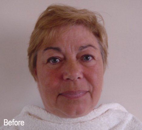A woman 's face is shown in a before photo