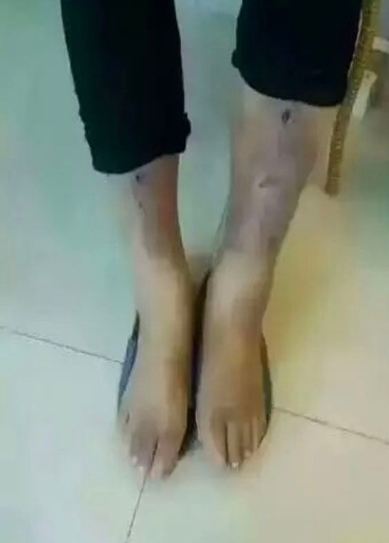 diabetic feet after Bioenergetic Meridians Massager treatment
