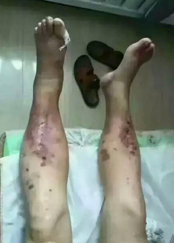 diabetic feet before Bioenergetic Meridians Massager treatment