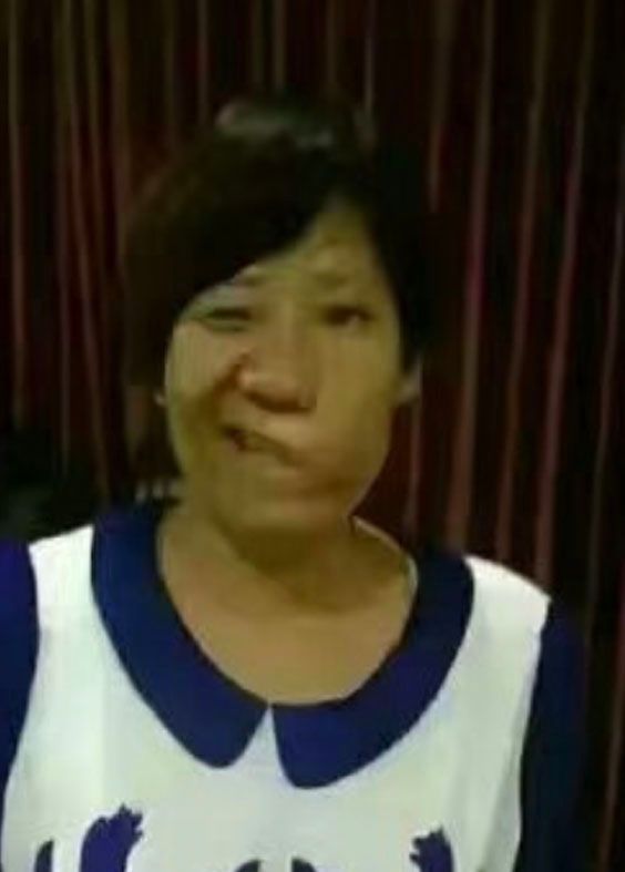facial paralysis before Bioenergetic Meridians Massager treatment