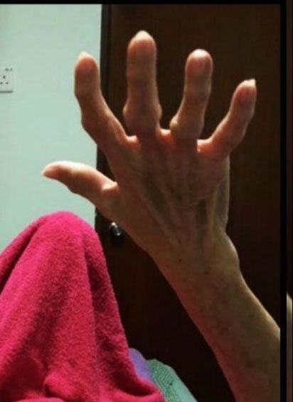 arthritic hands after Bioenergetic Meridians Massager treatment