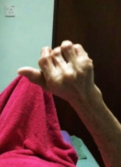 arthritic hands before Bioenergetic Meridians Massager treatment