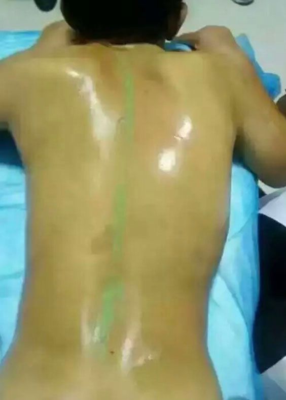 scoliosis after Bioenergetic Meridians Massager treatment