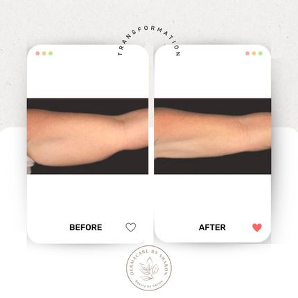 Een voor en na foto van de arm van een vrouw