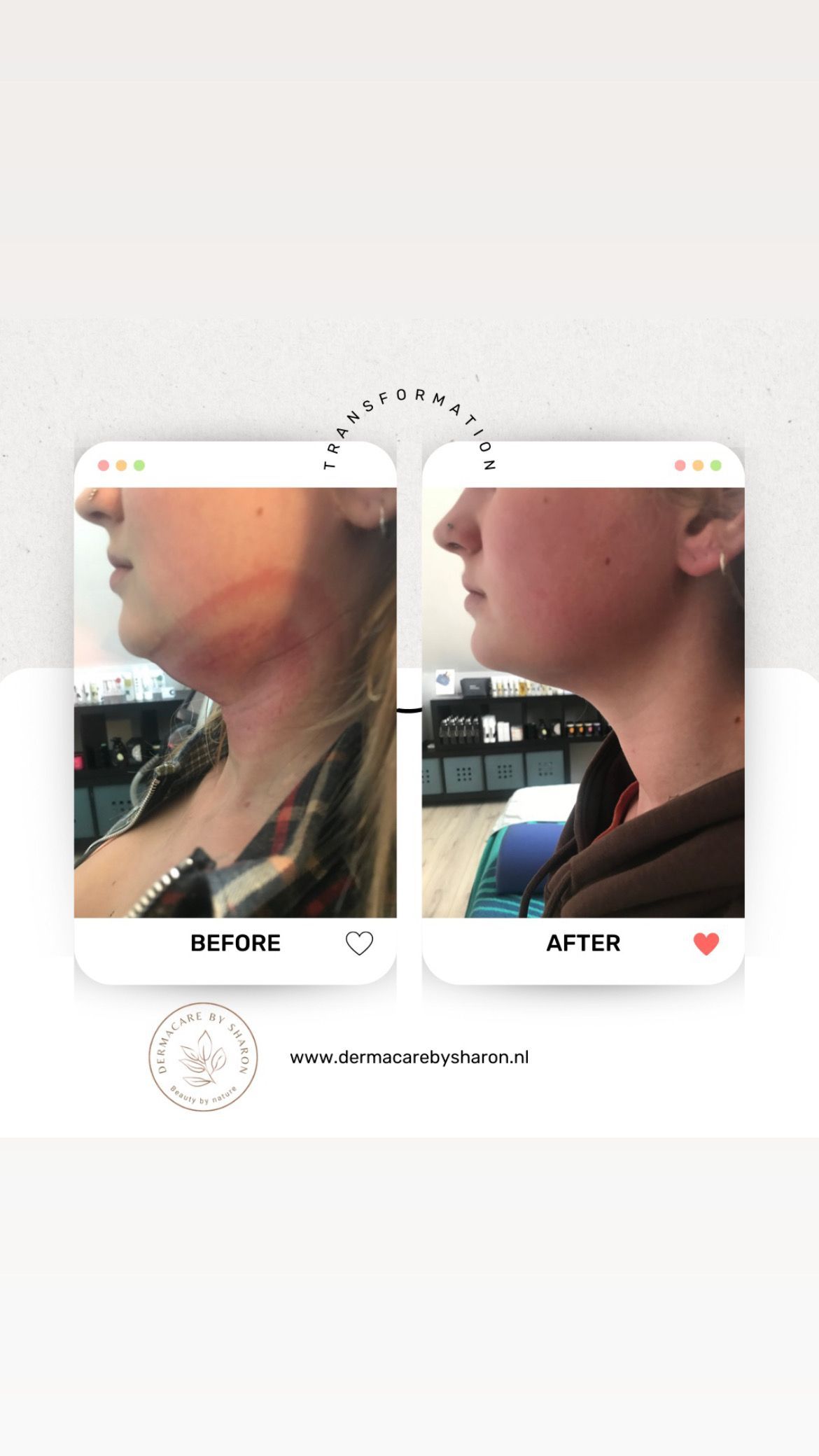 Twee foto's van de nek van een vrouw voor en na de operatie.