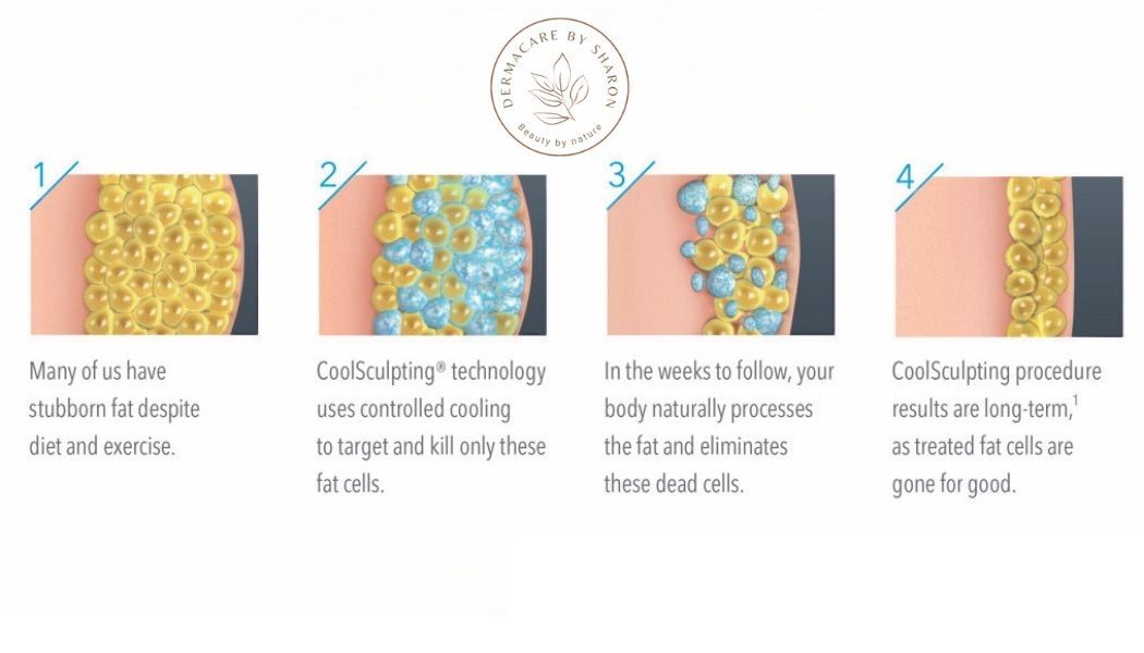 Een diagram dat de fasen van een liposuctieprocedure toont.