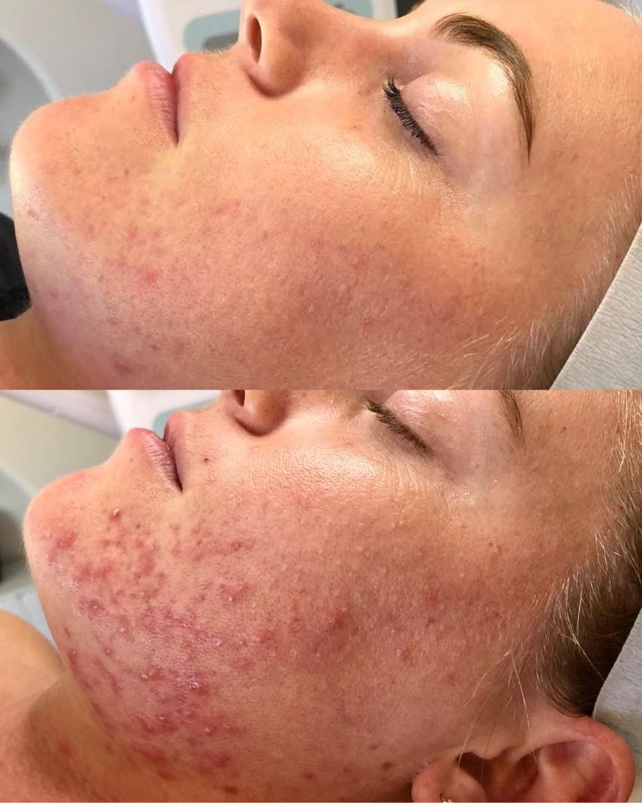 Een voor en na foto van het gezicht van een vrouw met acne.