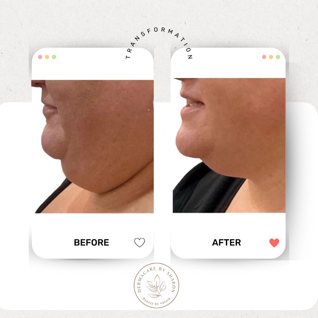 Een voor en na foto van de nek en kin van een vrouw