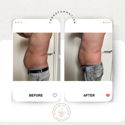 Een voor en na foto van de maag van een man