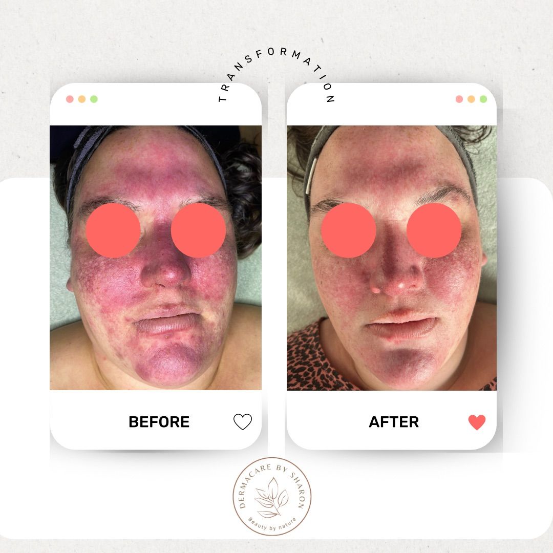 Een voor en na foto van het gezicht van een vrouw