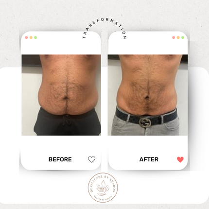 Een voor en na foto van de maag van een man.