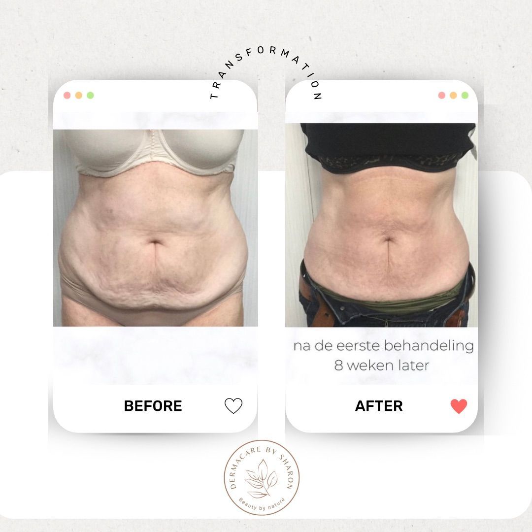 Een voor en na foto van de buik van een vrouw