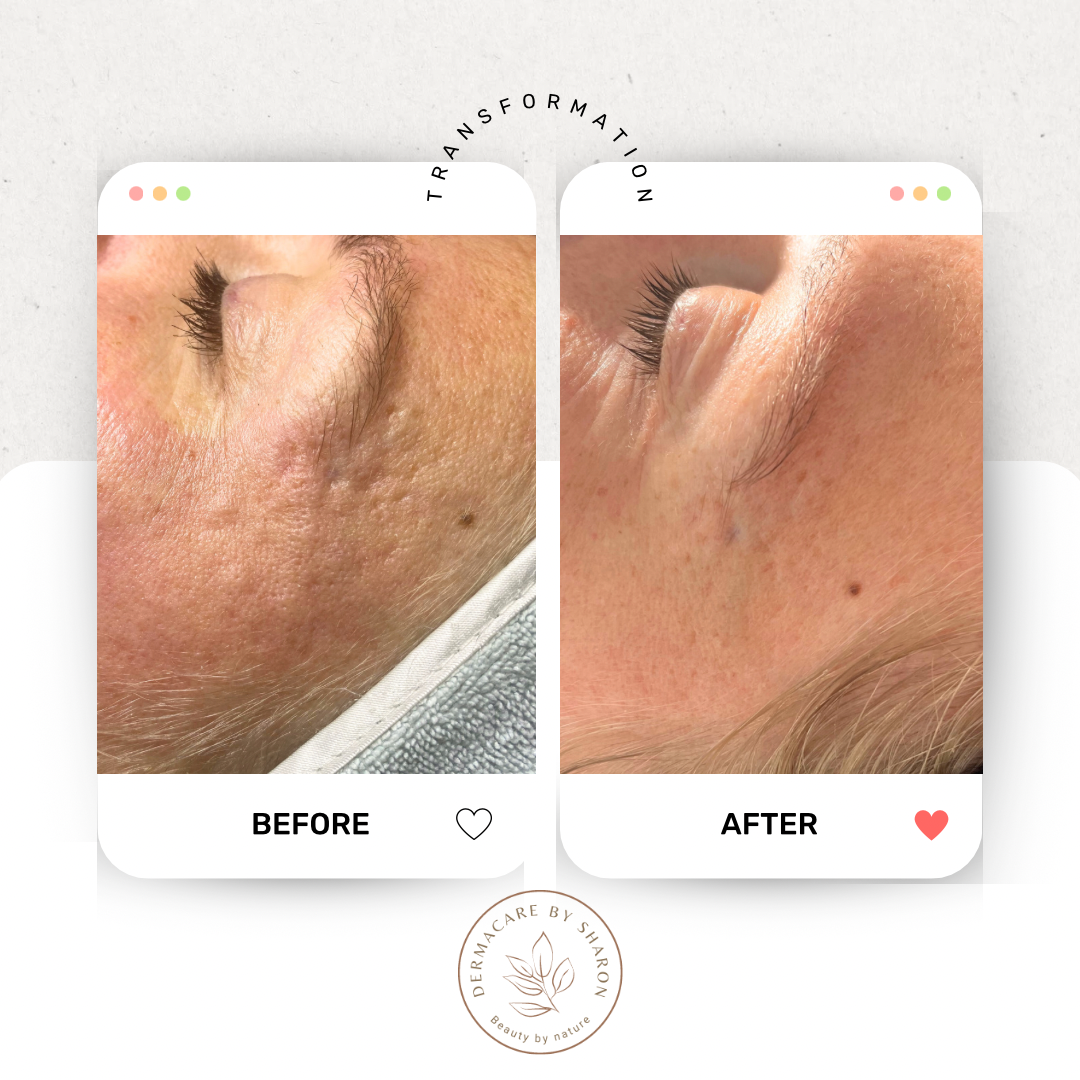 Microneedling