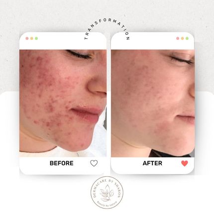 Een voor en na foto van het gezicht van een vrouw met acne.