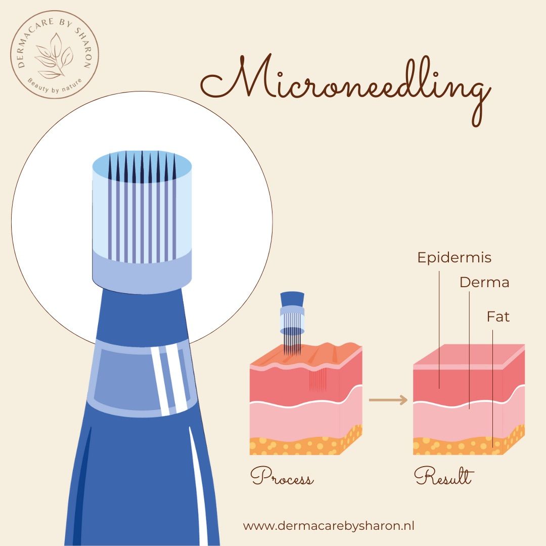 Een diagram dat het proces van microneedling op de huid laat zien