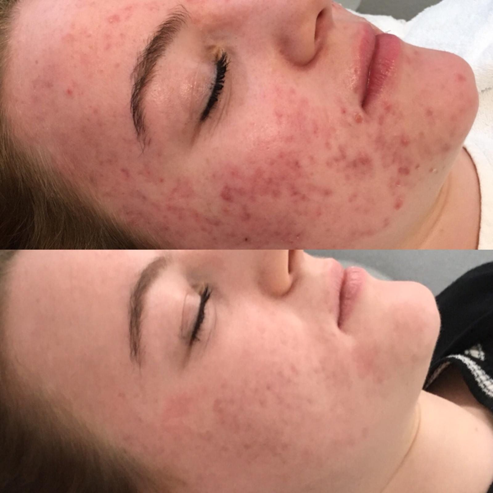 Een voor en na foto van het gezicht van een vrouw met acne.