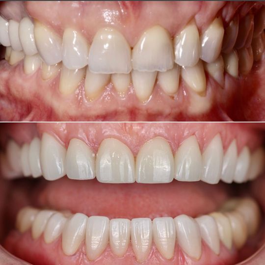a before and after picture of a person 's teeth