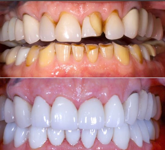 a before and after picture of a person 's teeth