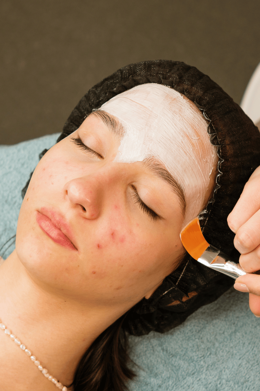 woman treating her acne