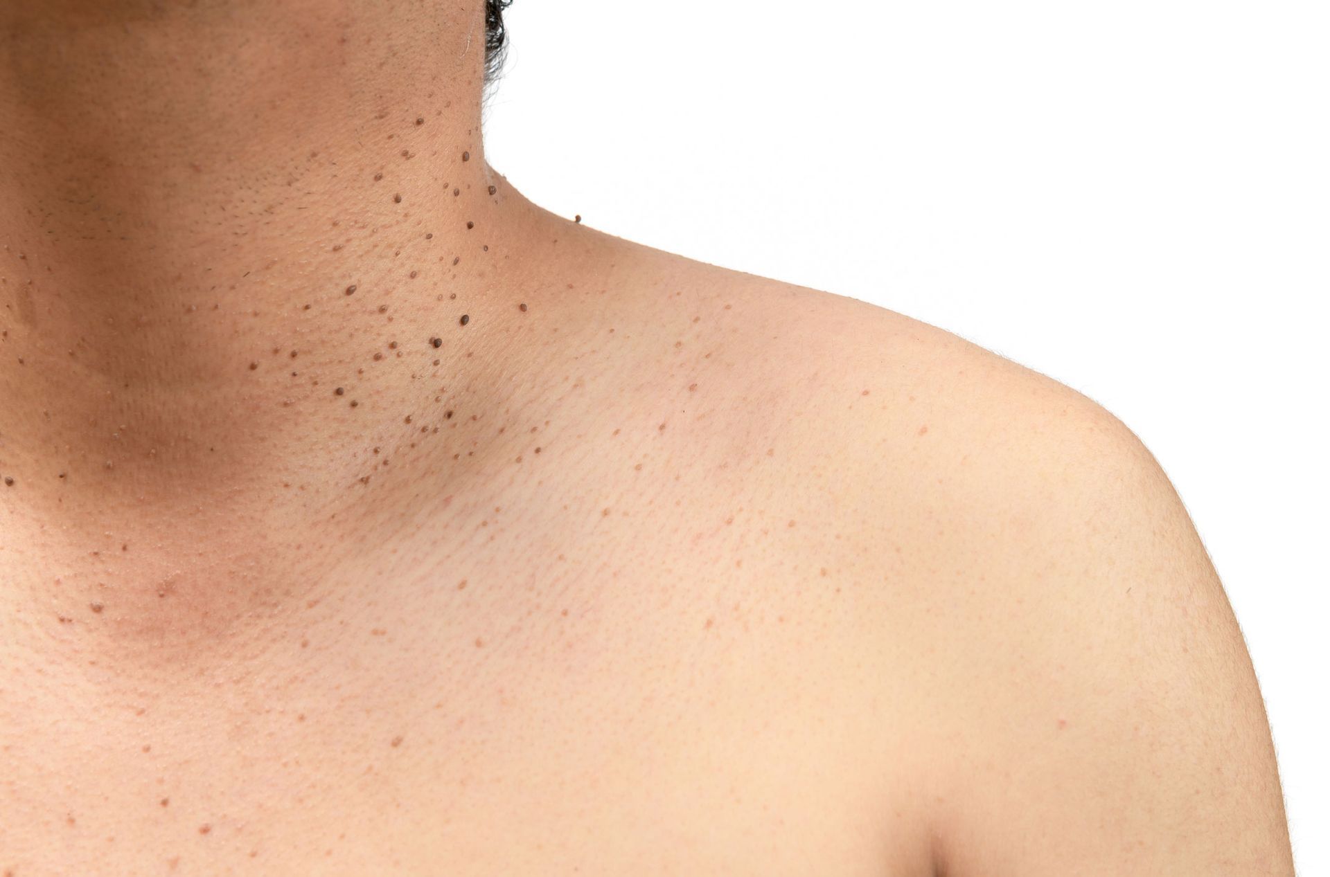 A Close Up Of A Man 's Neck — Pittsburgh, PA — South Hills Dermatology, PC