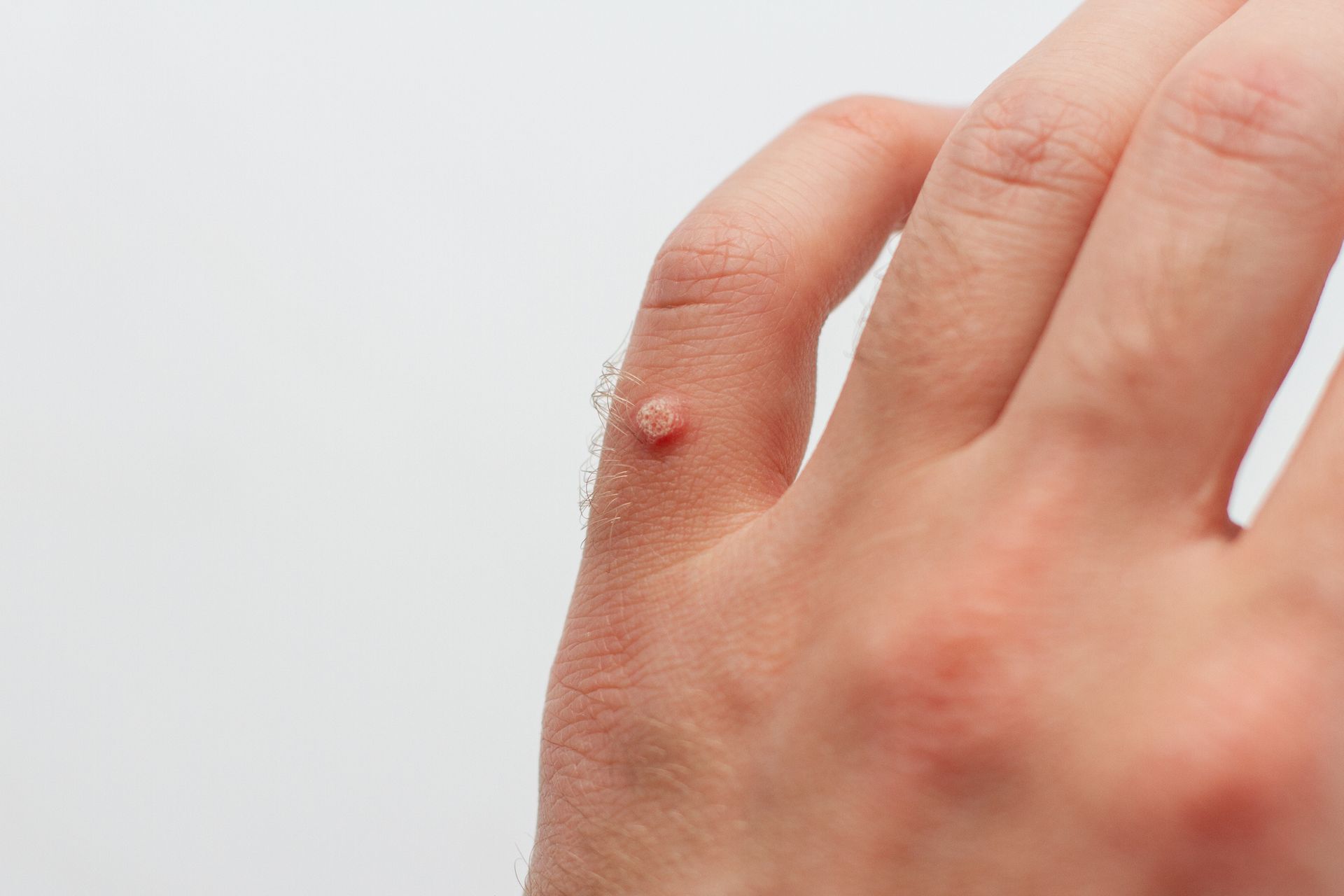 A close up of a person 's hand with a wart on the thumb. — Pittsburgh, PA — South Hills Dermatology, PC