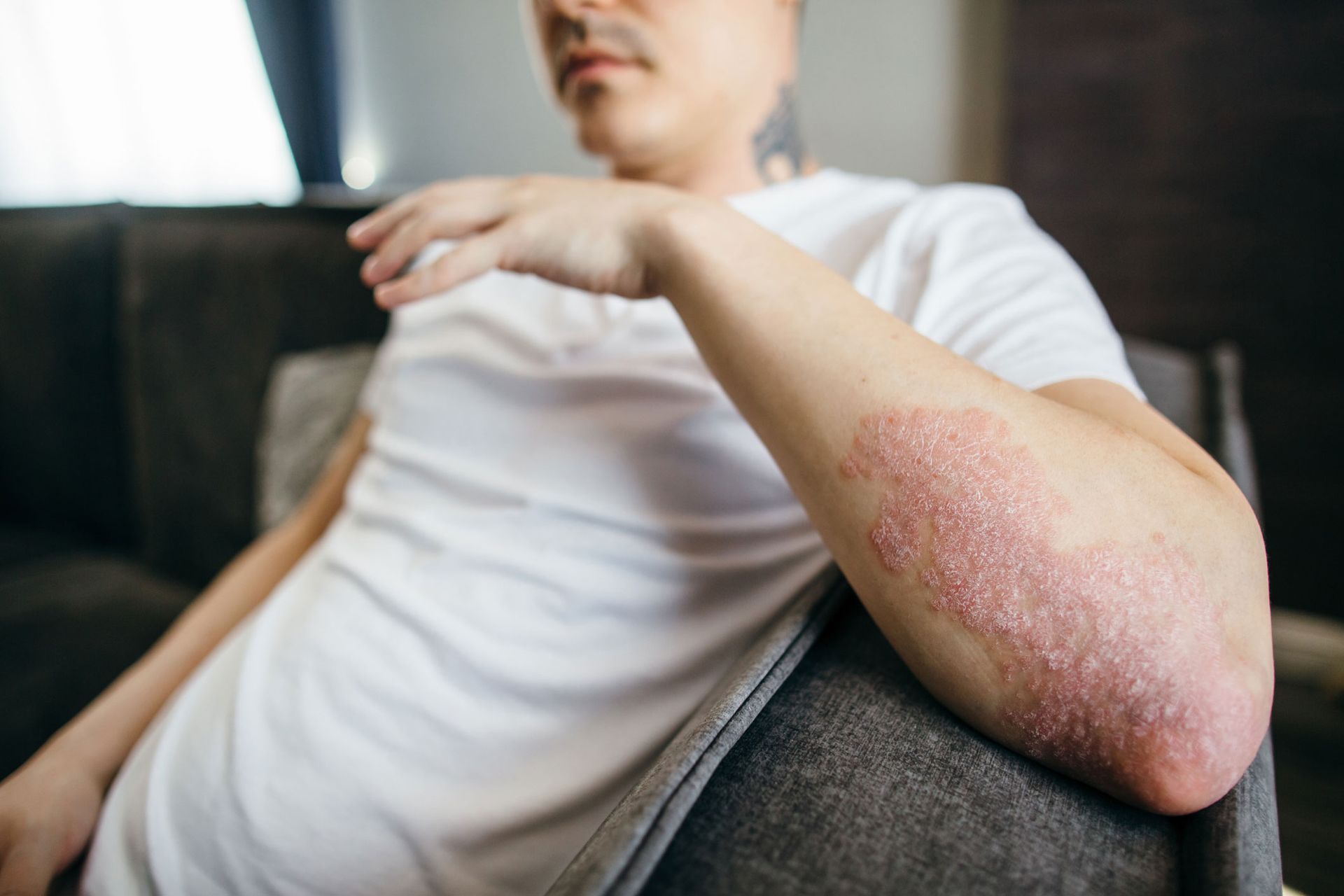 A Man Sitting On A Couch — Pittsburgh, PA — South Hills Dermatology, PC